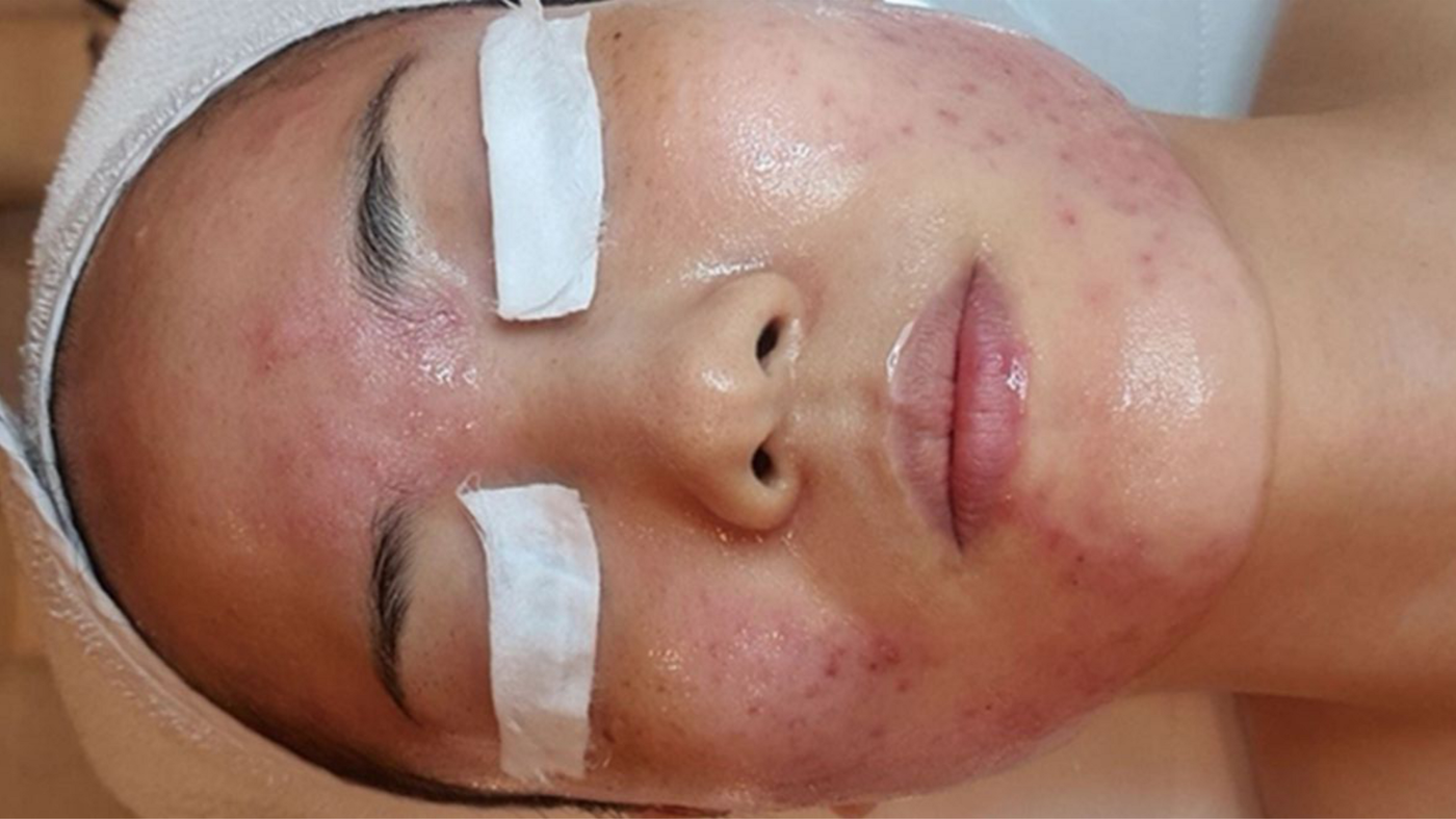 Before Treatment