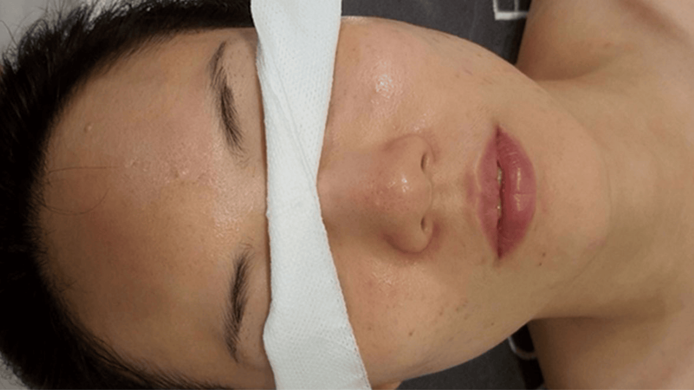 After Treatment