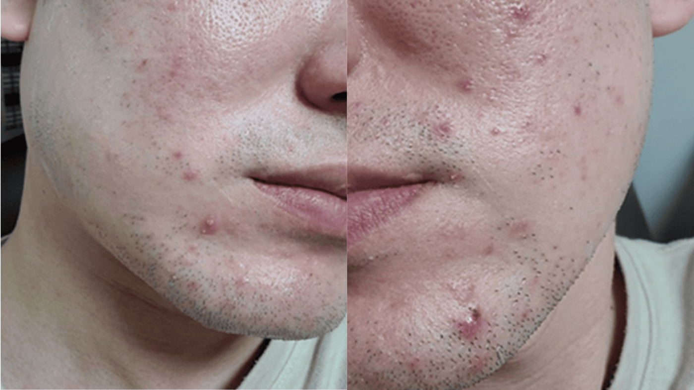 Before Treatment