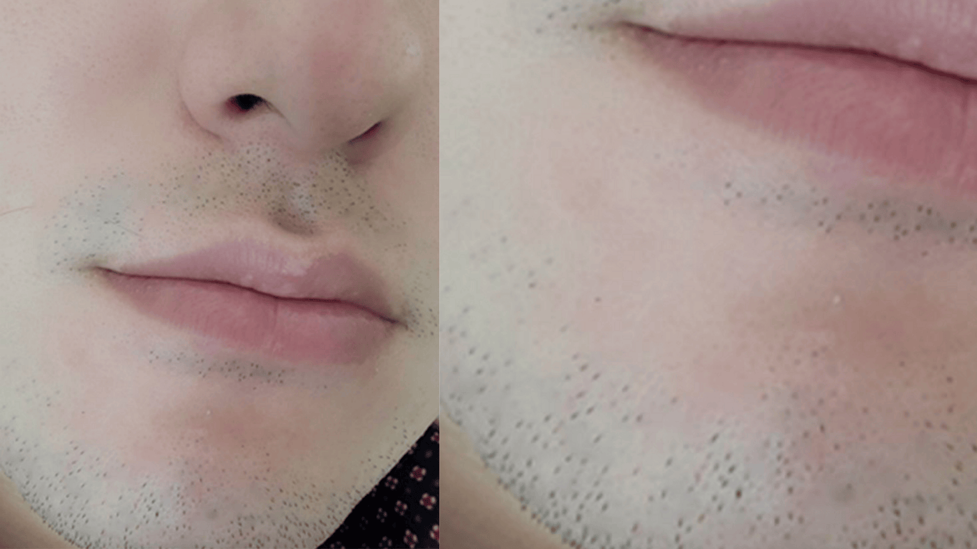 After Treatment