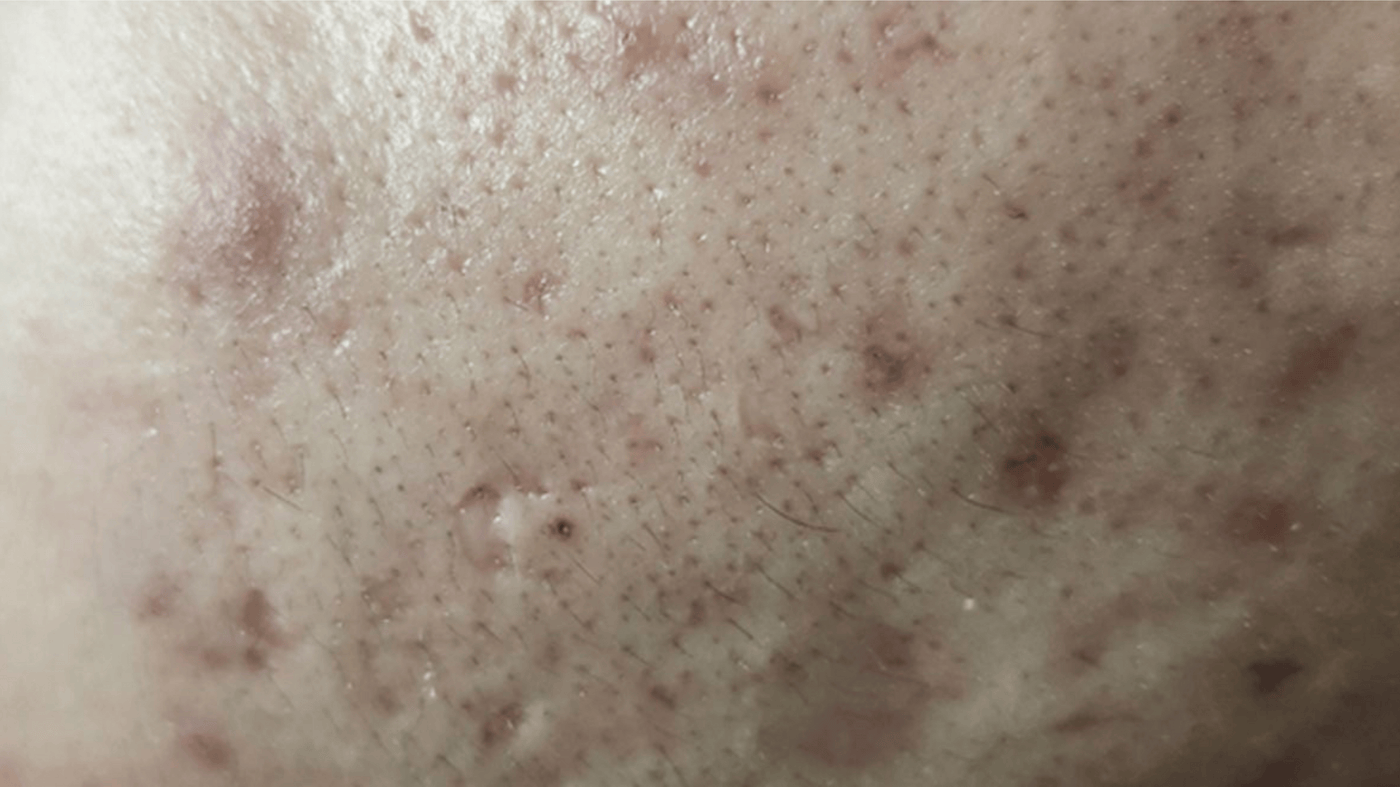 Before Treatment