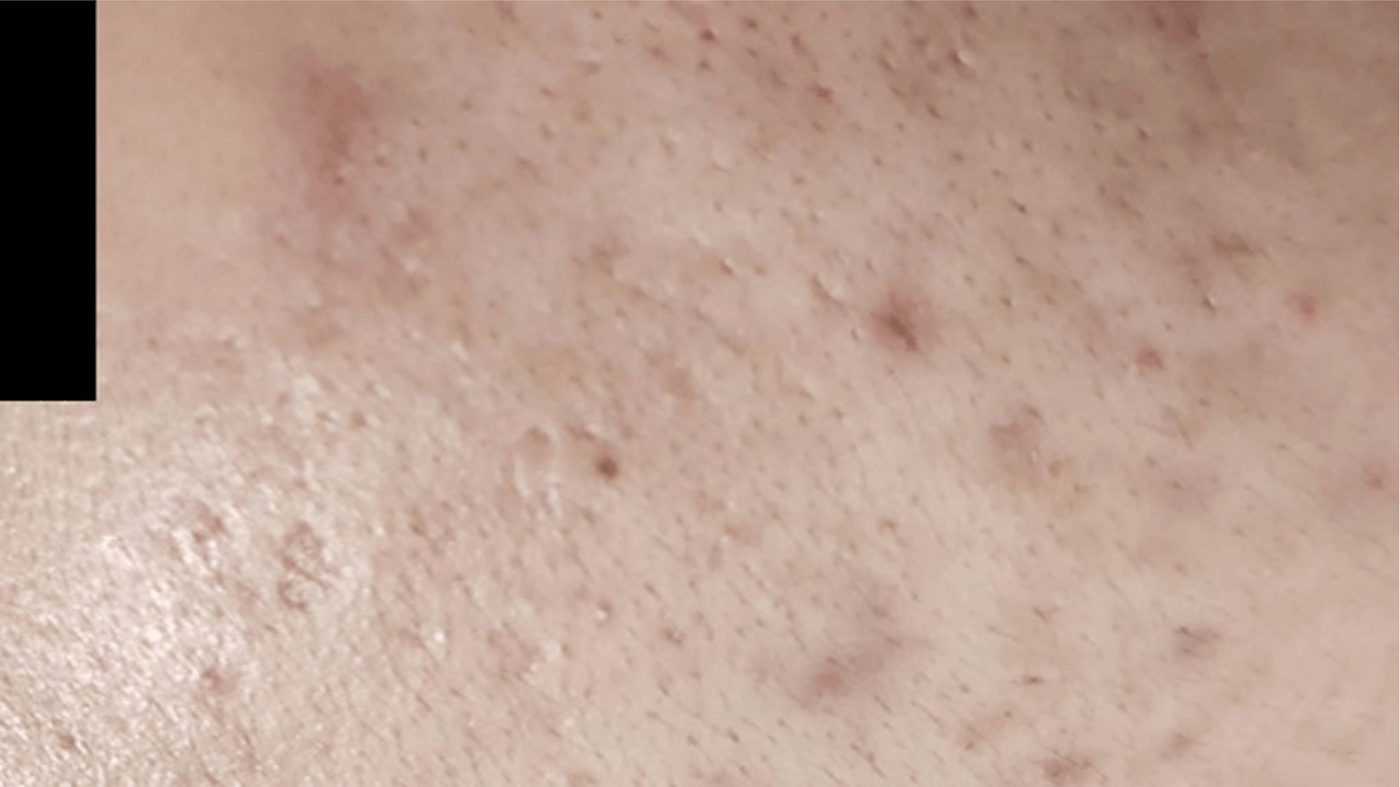 After Treatment