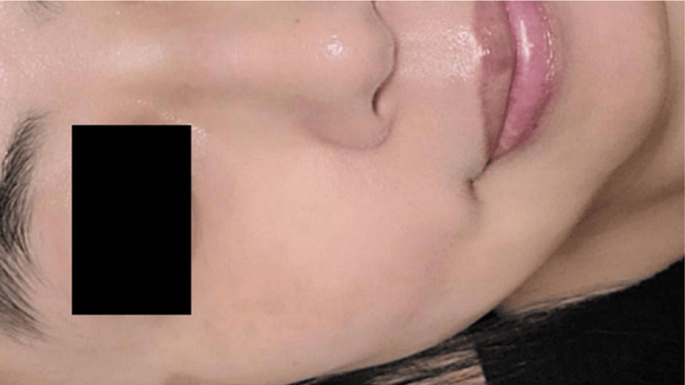 After Treatment