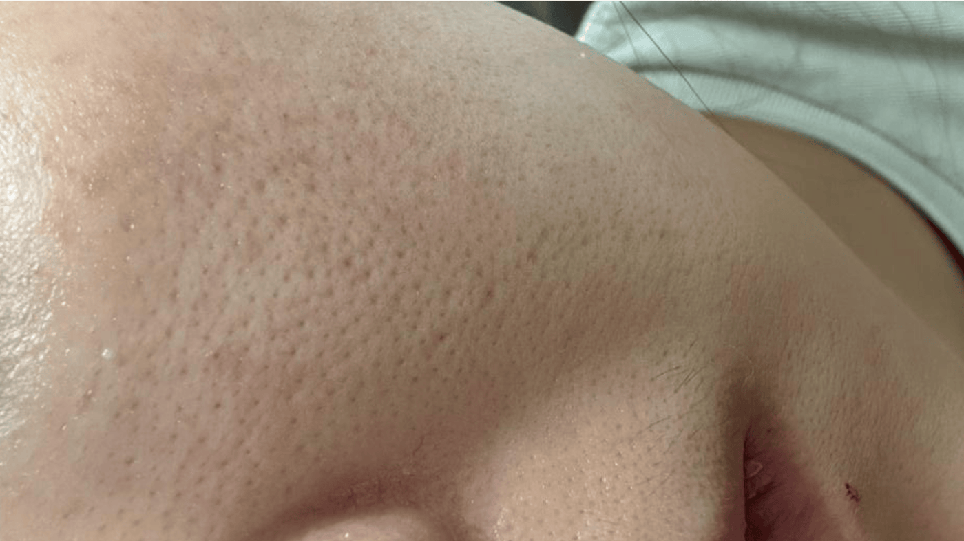 Before Treatment