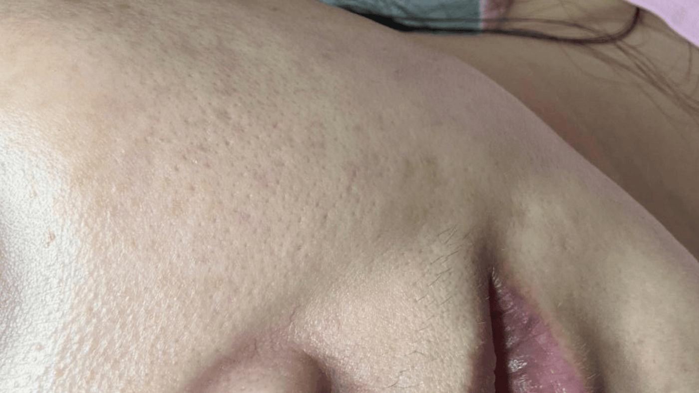After Treatment