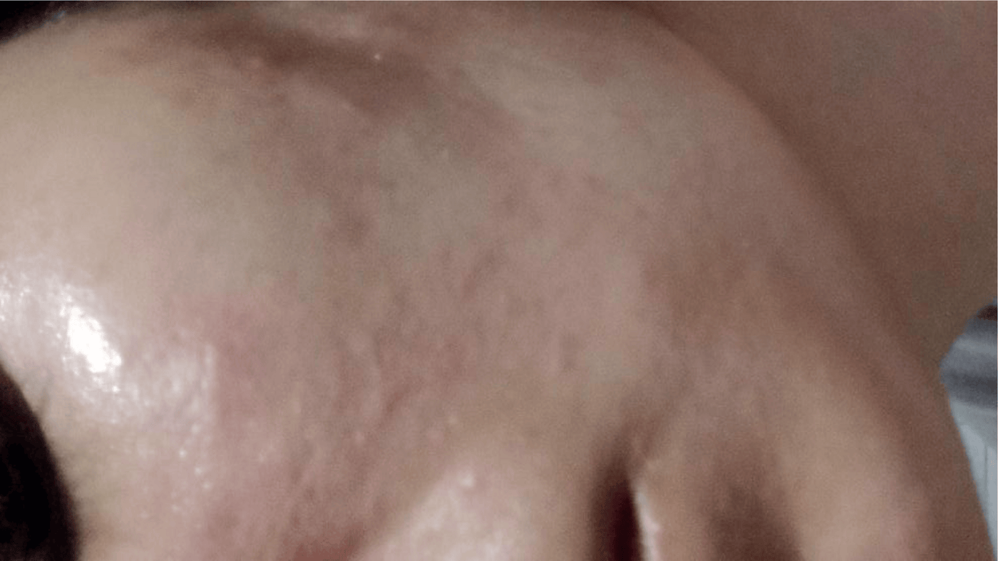 Before Treatment