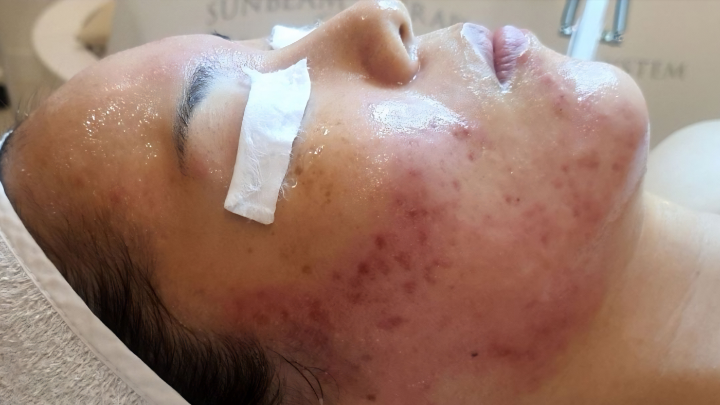 Before Treatment