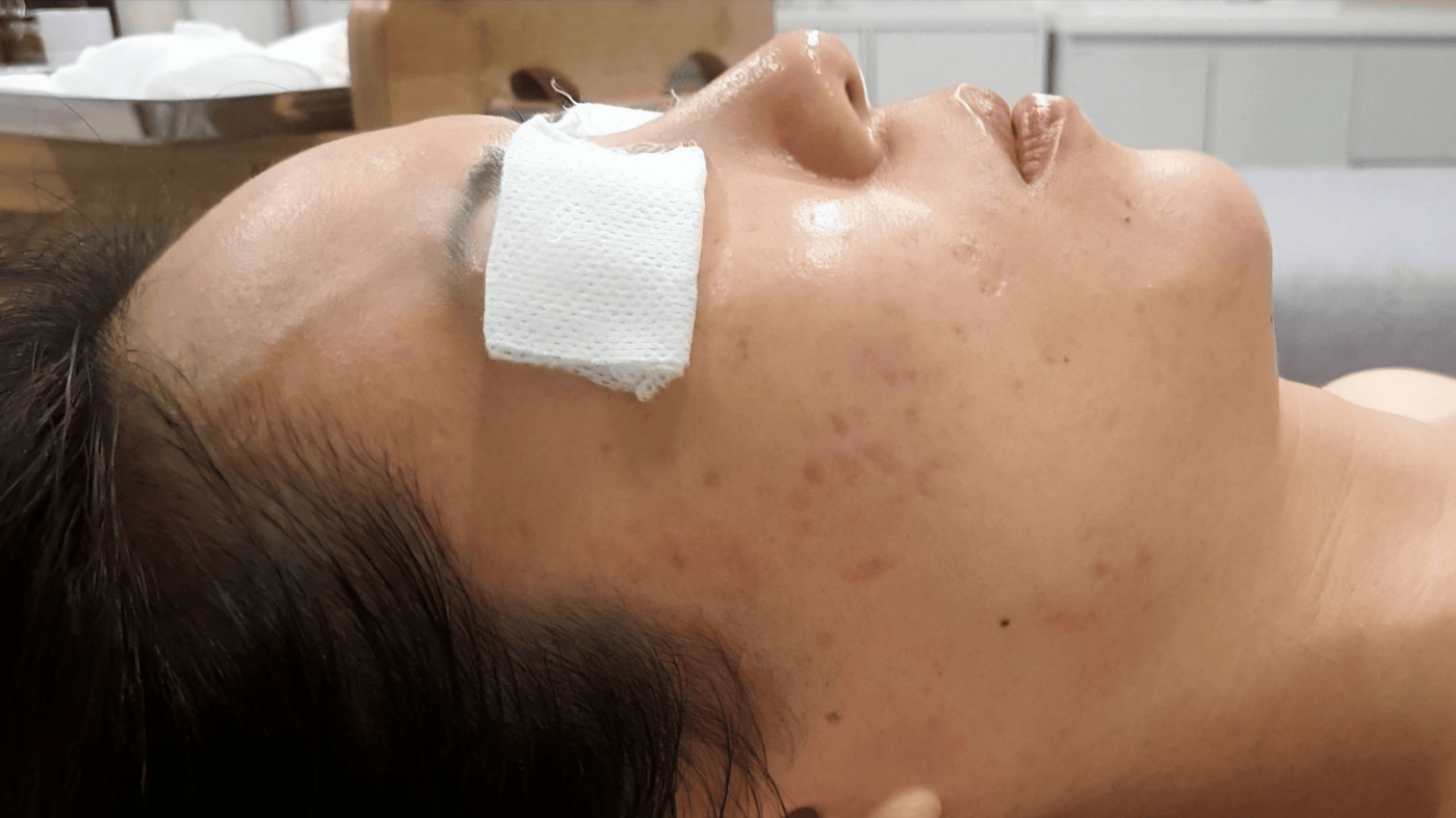 After Treatment