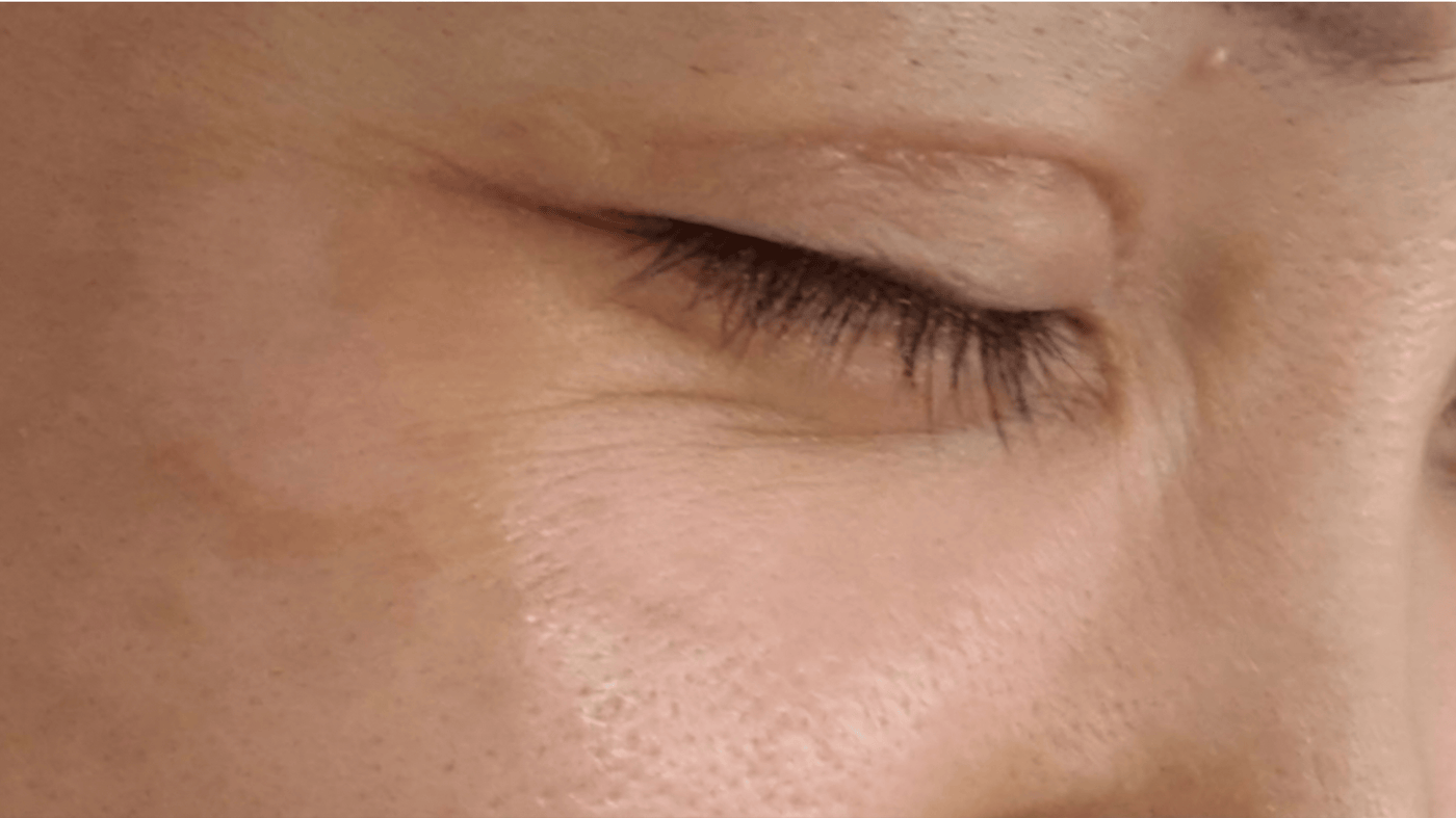 Before Treatment